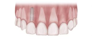 Diagram showing Tooth replacement with a dental implant